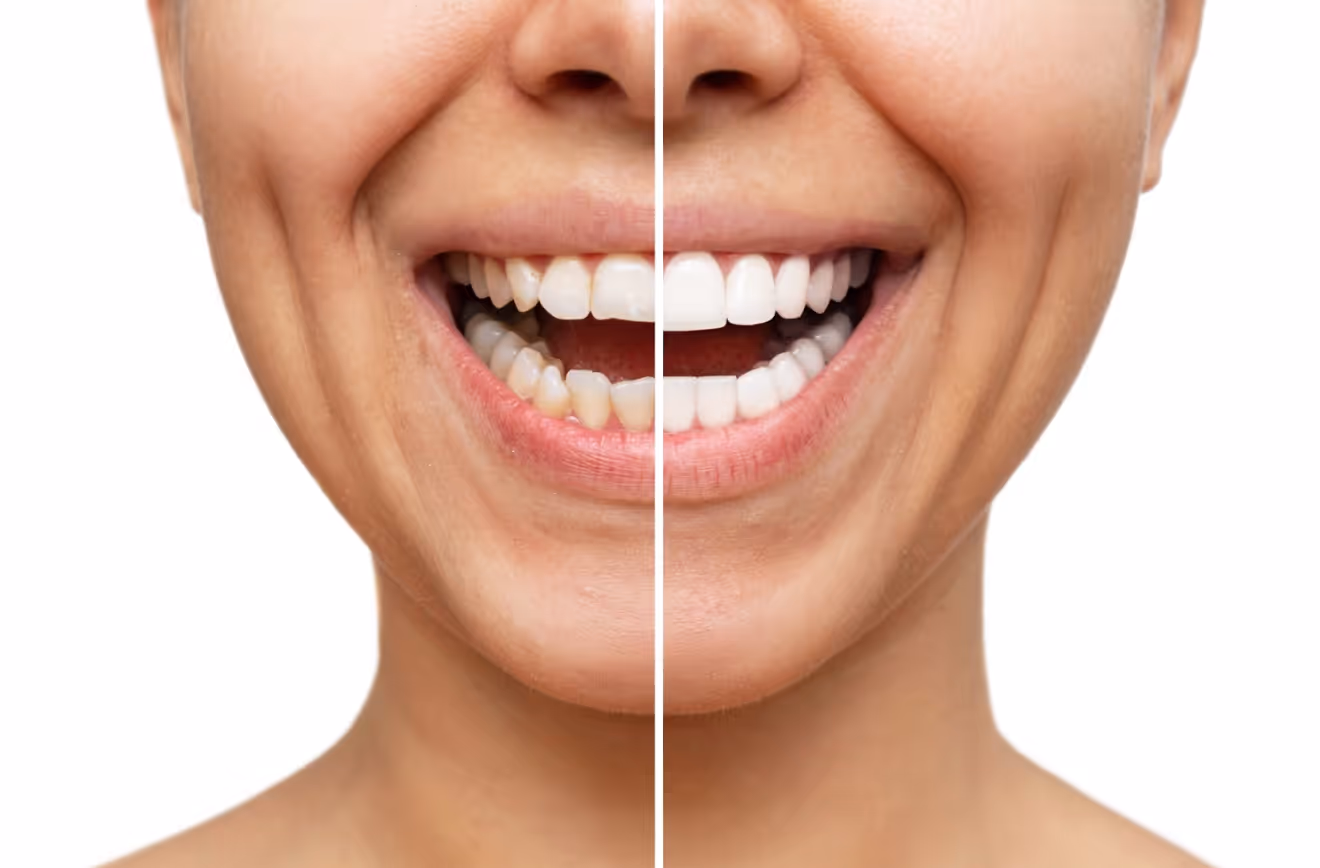 Close-up before-and-after comparison of teeth whitening results.
