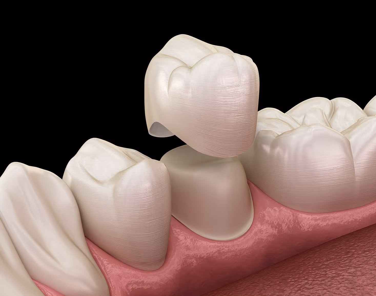 tooth crown