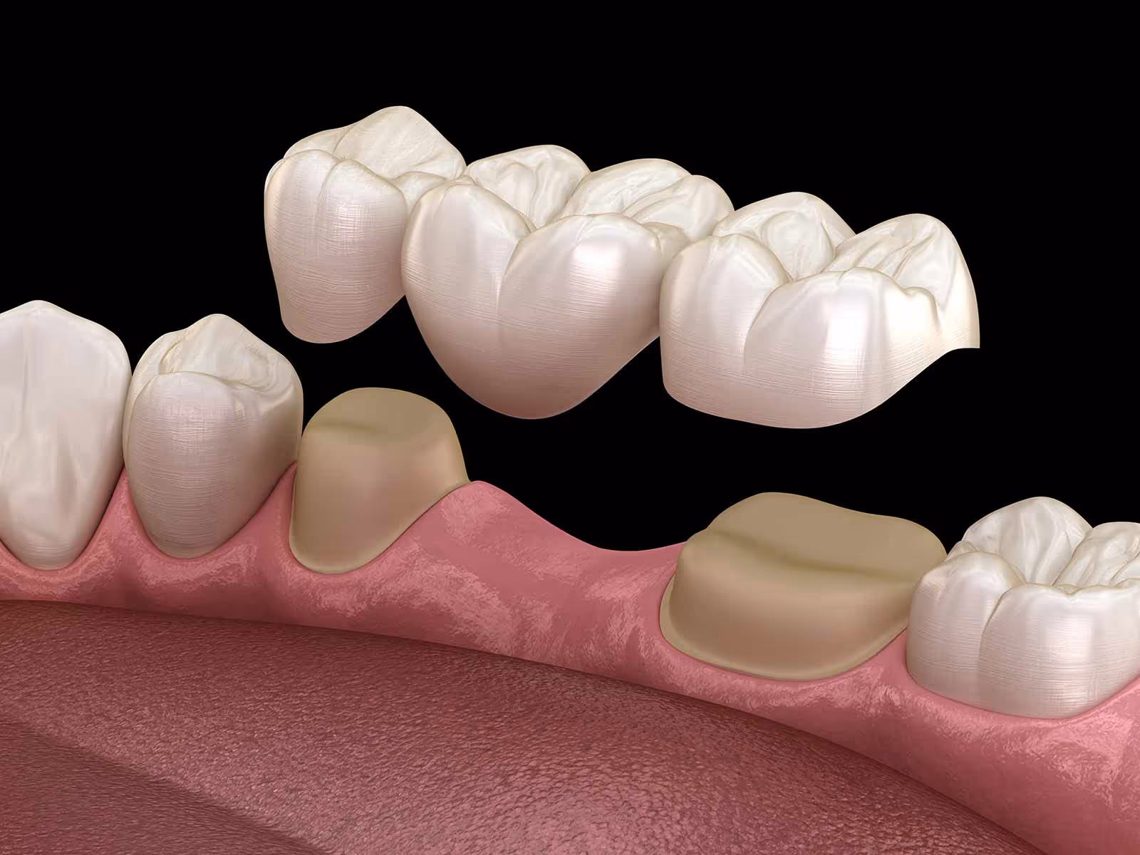 teeth bridge