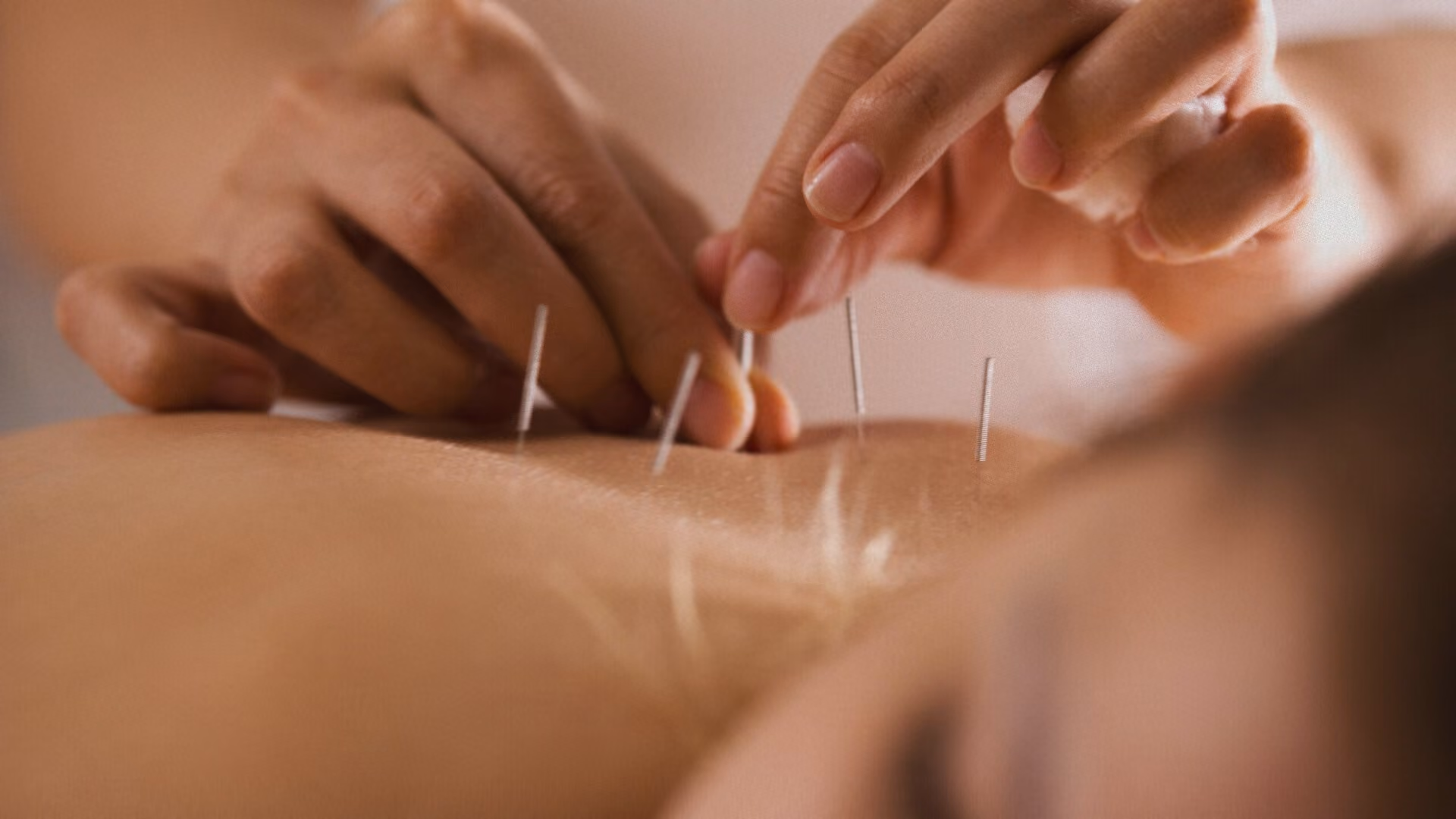 Médecin réalisant une séance d’acupuncture sur le dos d’un patient allongé.