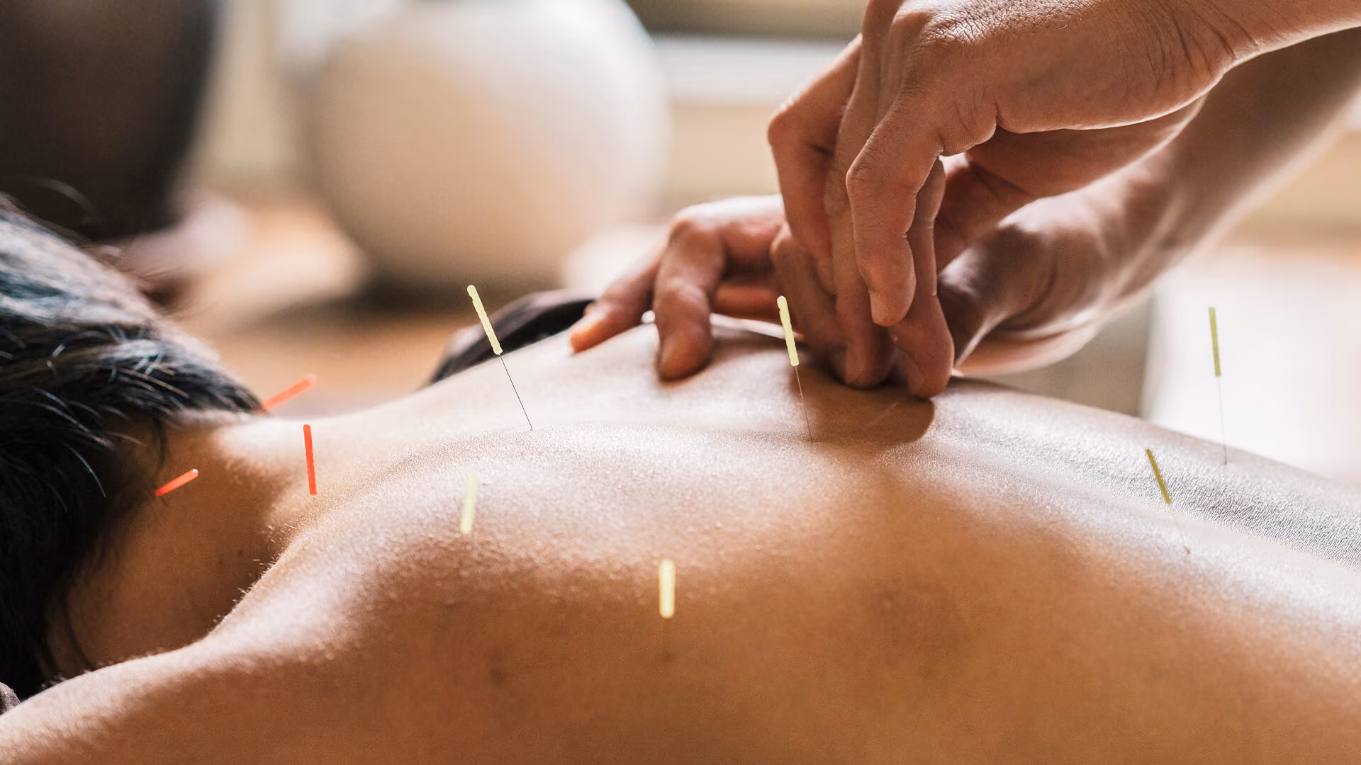 Médecin tenant une aiguille d’acupuncture au-dessus du dos d’un patient.