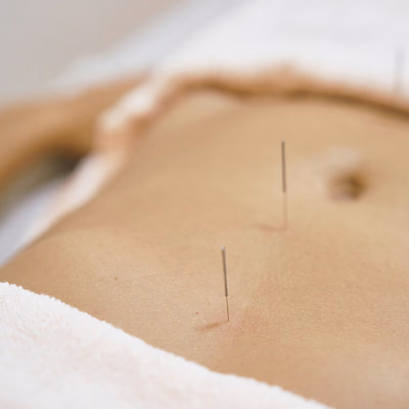 Médecin tenant une aiguille d’acupuncture au-dessus du dos d’un patient.