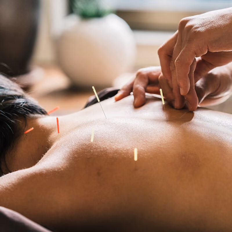 Médecin tenant une aiguille d’acupuncture au-dessus du dos d’un patient.