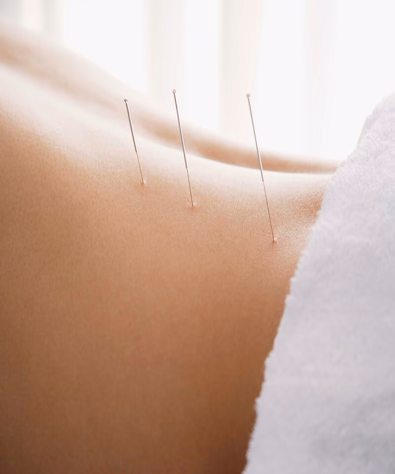 Médecin manipulant une aiguille d’acupuncture sur le dos d’un patient.