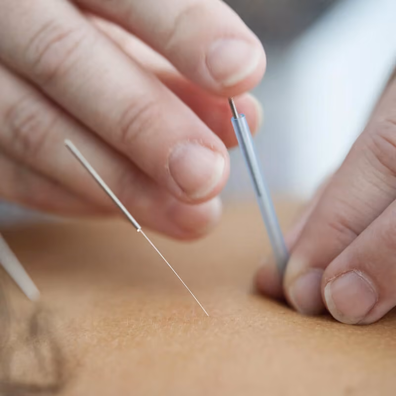 Médecin posant une aiguille d’acupuncture sur le dos d’un patient.