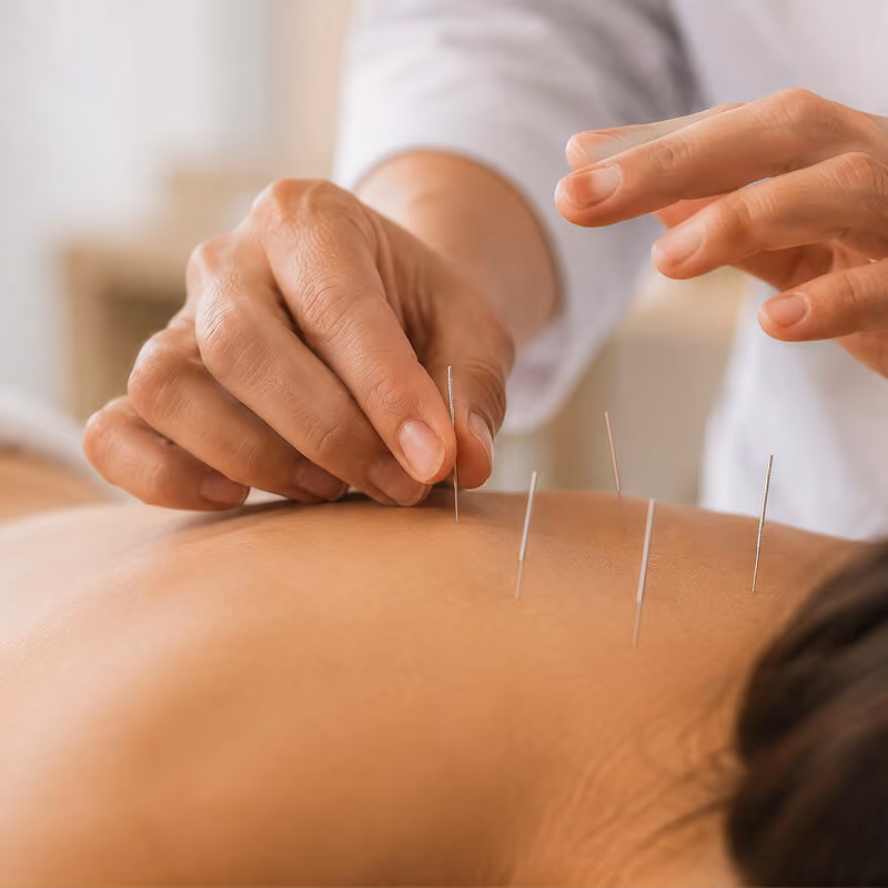 Médecin réalisant une séance d’acupuncture sur un patient allongé.
