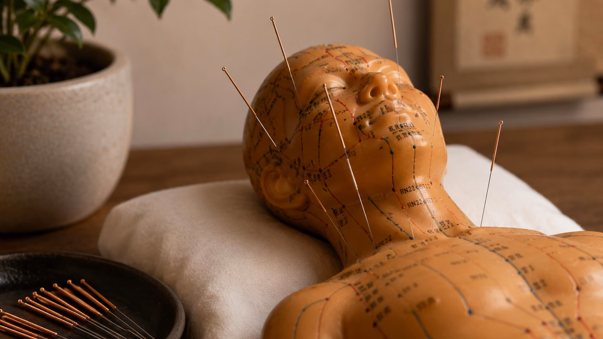 Patient allongé pendant une séance d’acupuncture médicale.