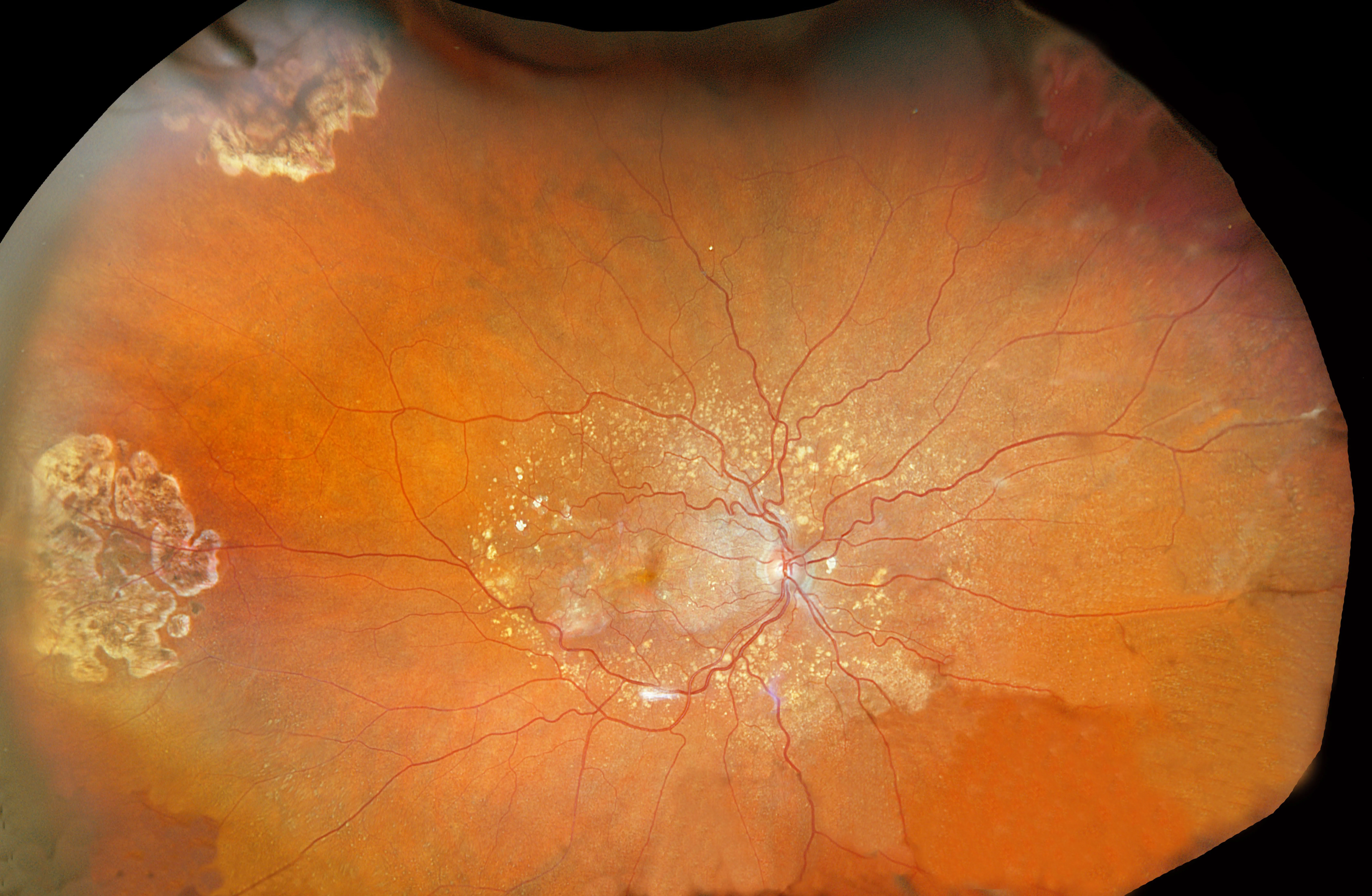 photo of retina, showing blood vessels