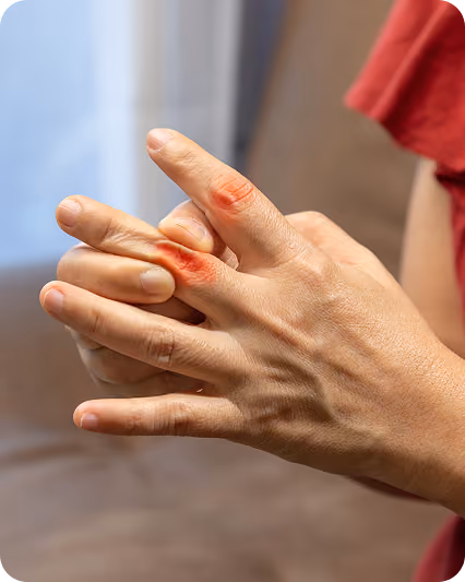 Close-up of hands with red, irritated skin on fingers, possibly from eczema or irritation.