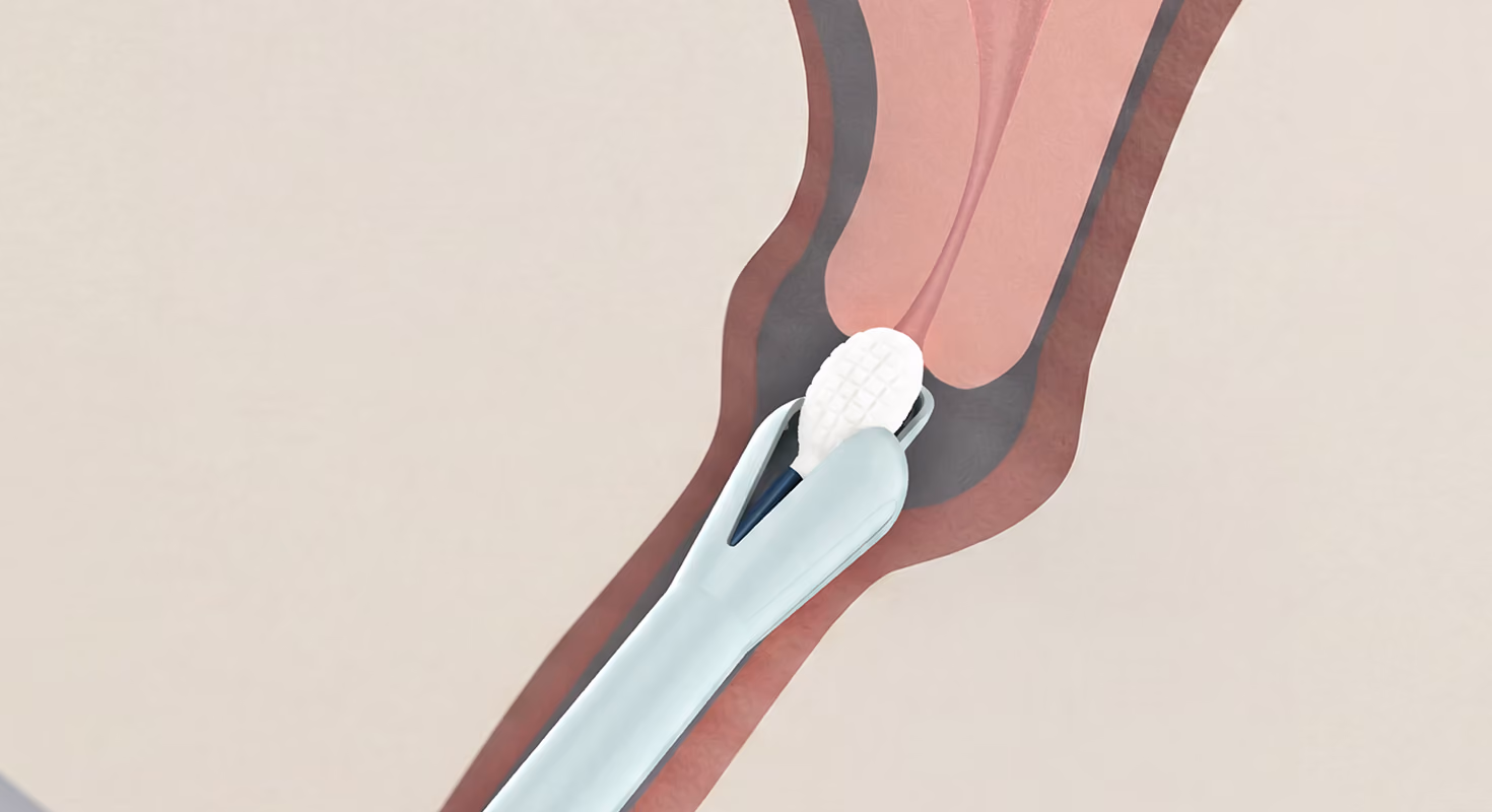A clean medical diagram demonstrating the Teal Wand. The soft white collection tip of the device is shown gently collecting a sample from the vaginal walls near the cervix, providing a clear and comfortable clinical explanation of the self-collection process.