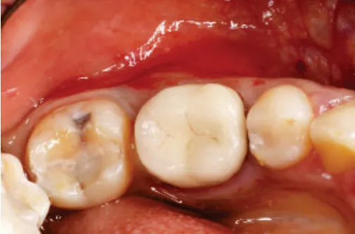 Klinische Ausgangssituation regio 36 mit parodontal-endodontischer Läsion