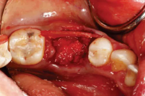 Eingebrachte laminäre Knochenmembran mit kortikalem Allograft