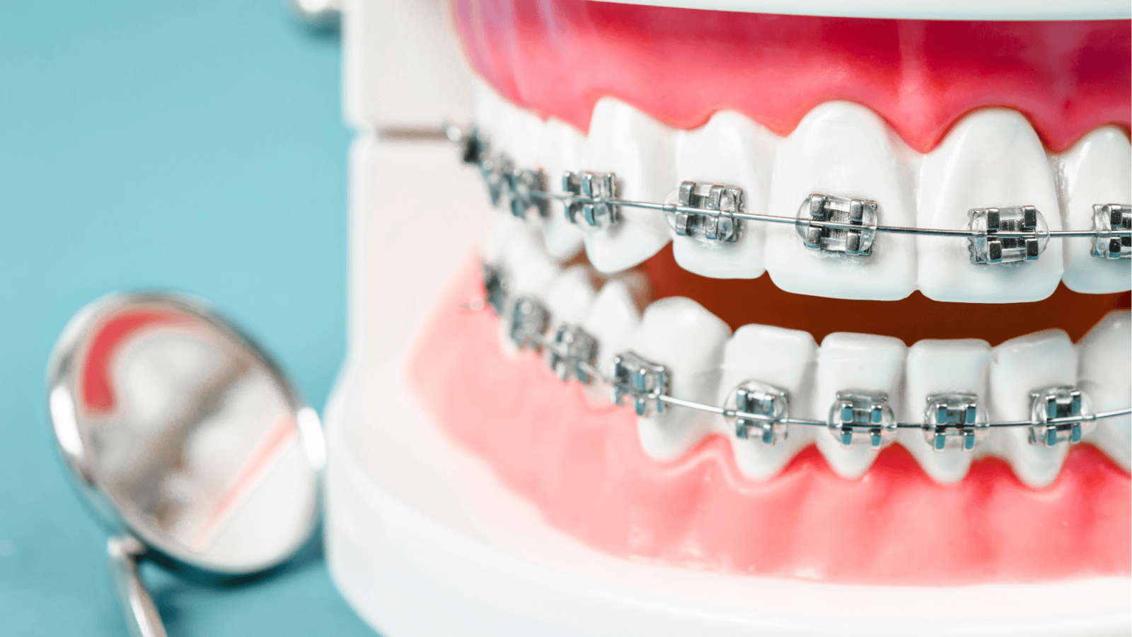 Metal Braces vs. Ceramic Braces: Which Option is Right for You?