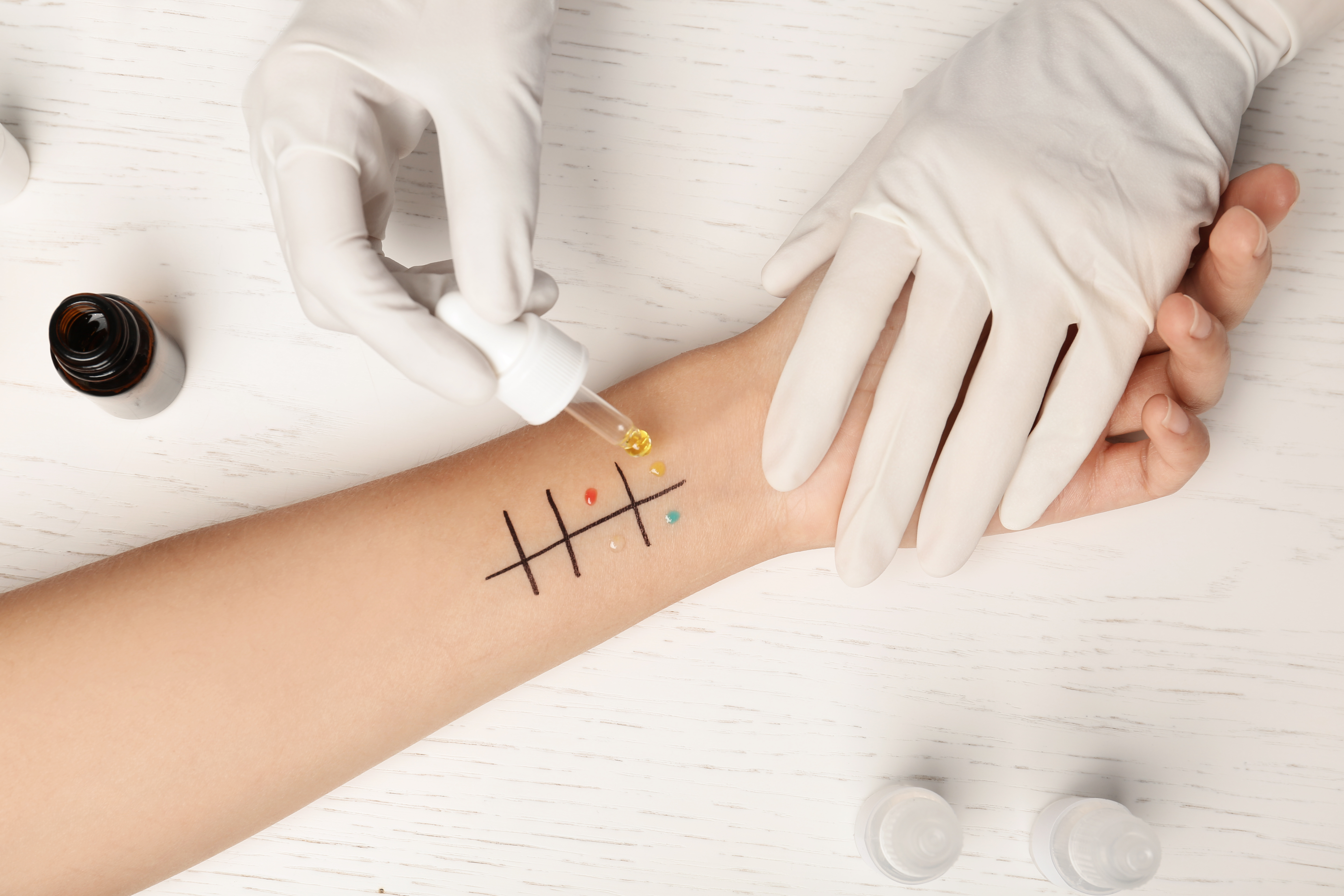 Allergy skin prick test on a child’s arm with drops of allergens applied