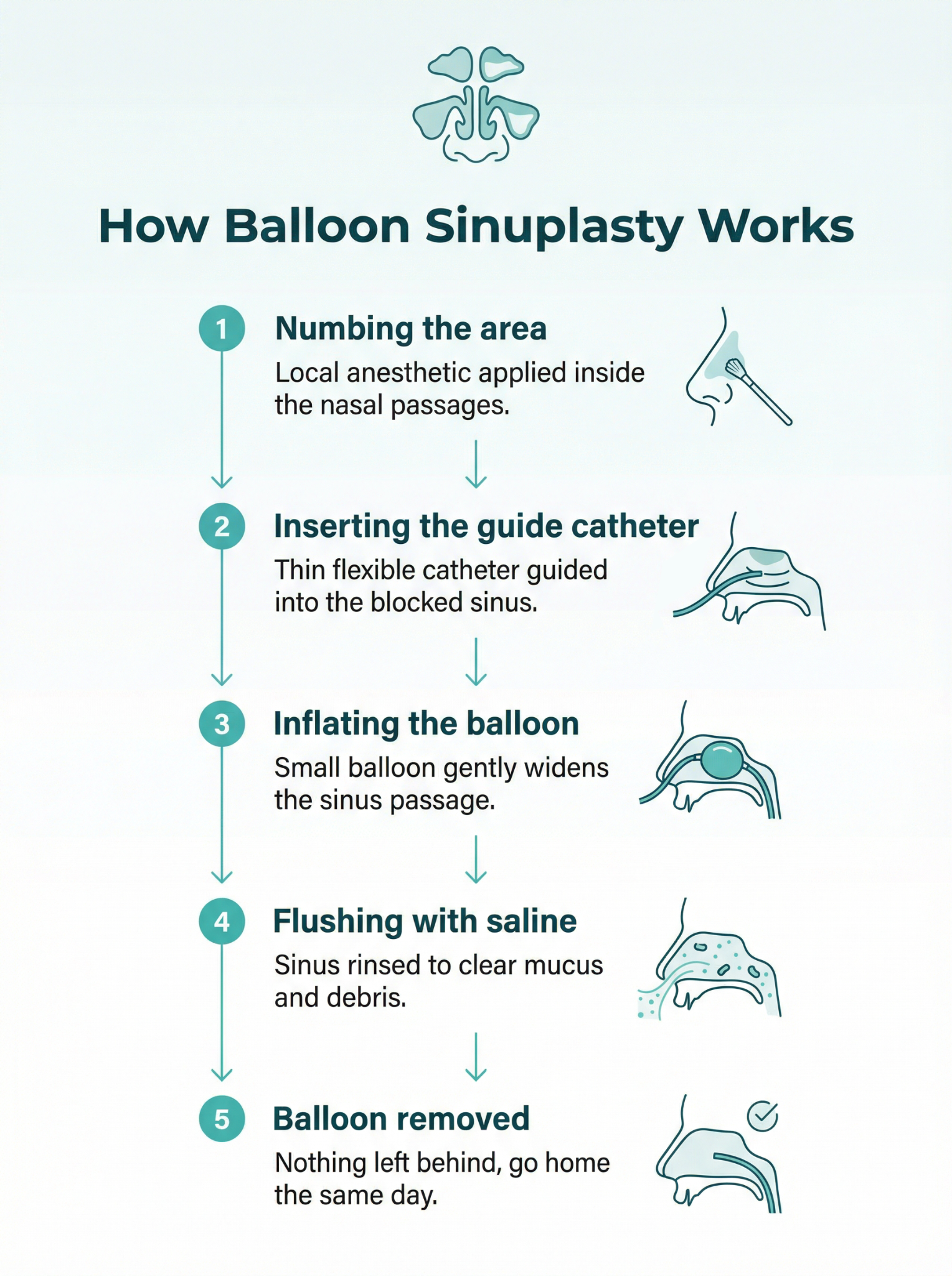 Diagram illustrating how a balloon catheter gently opens a blocked sinus passage during in-office balloon sinuplasty