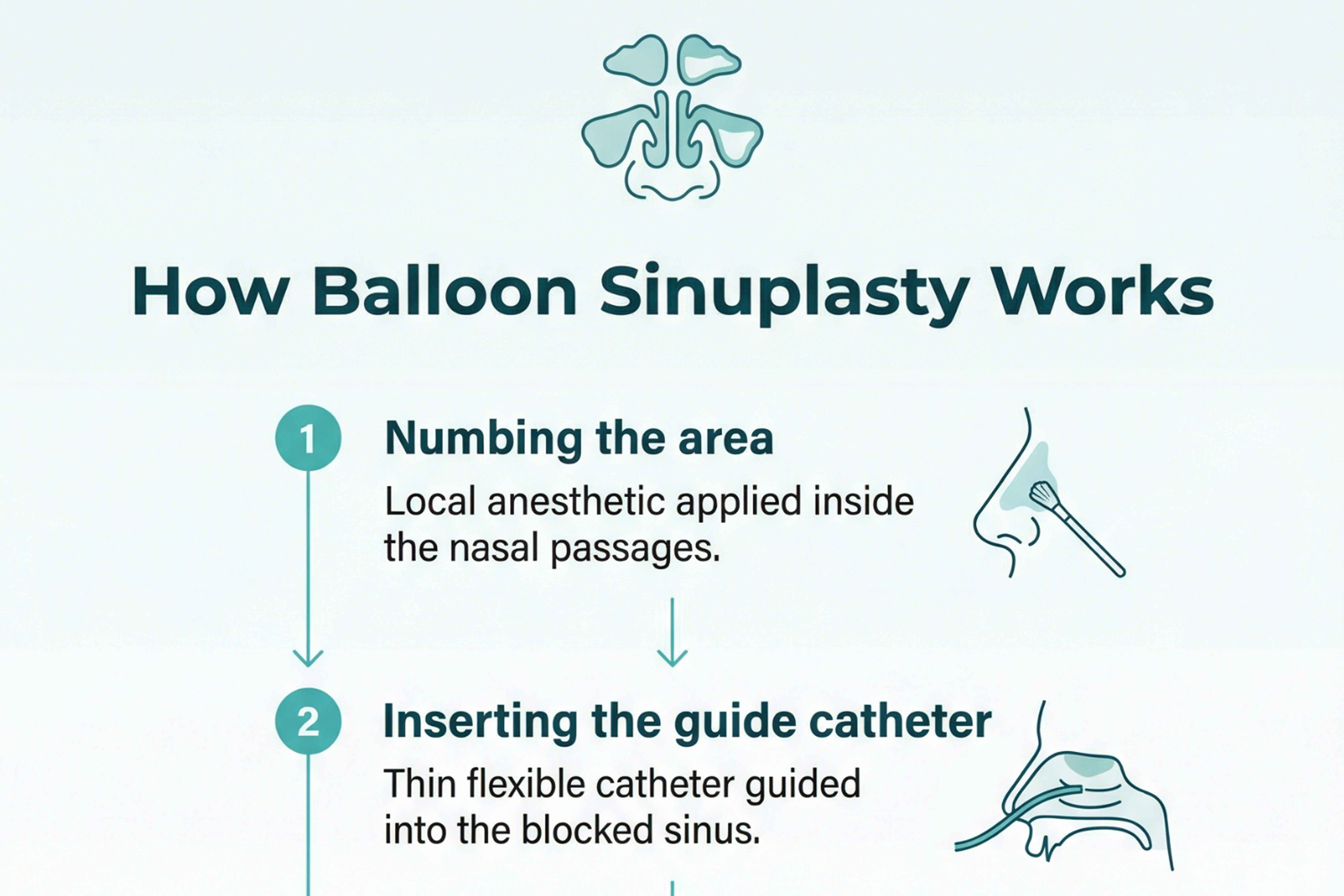 Diagram illustrating how a balloon catheter gently opens a blocked sinus passage during in-office balloon sinuplasty