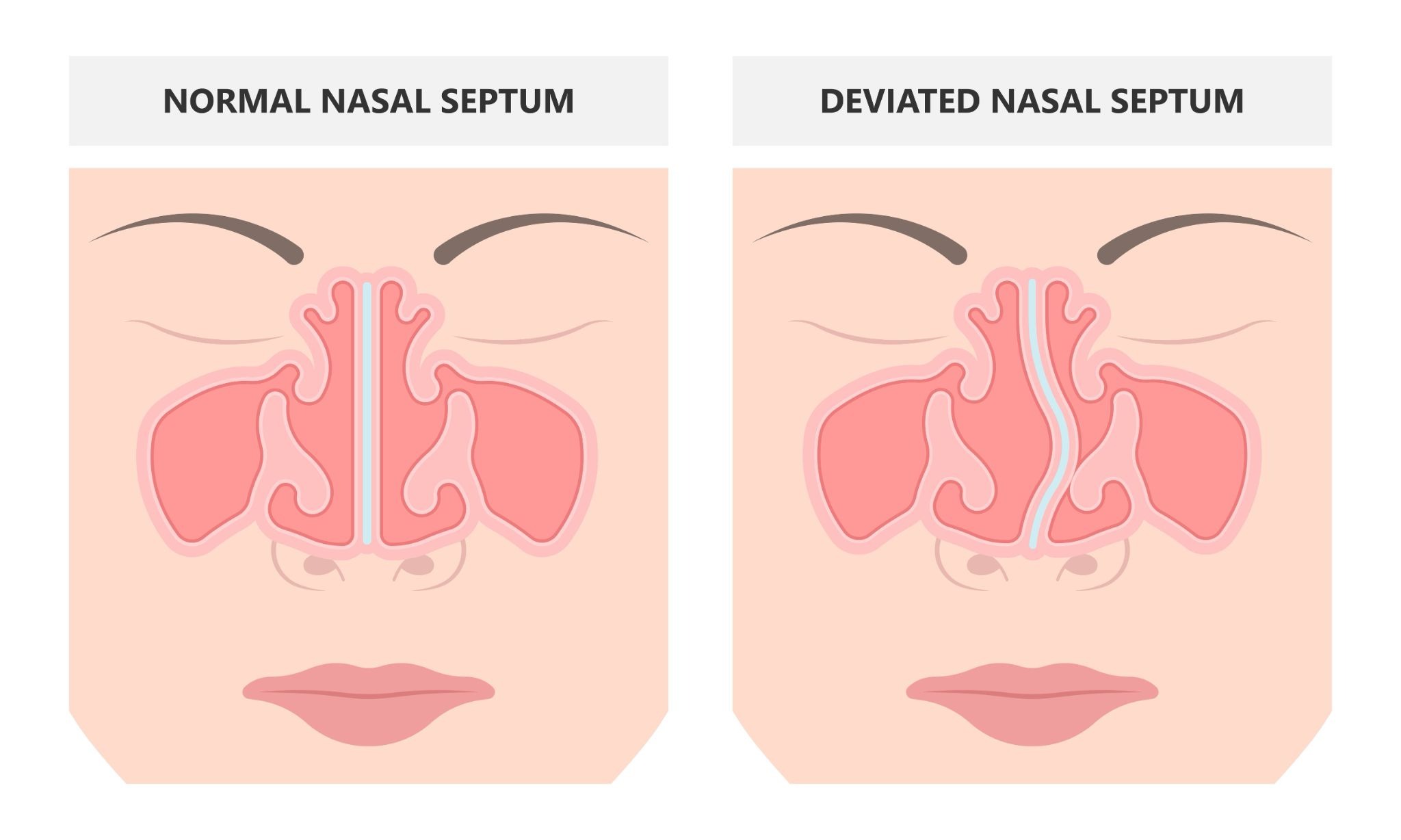 A simple medical illustration showing a centered nasal septum on the left and a deviated septum on the right