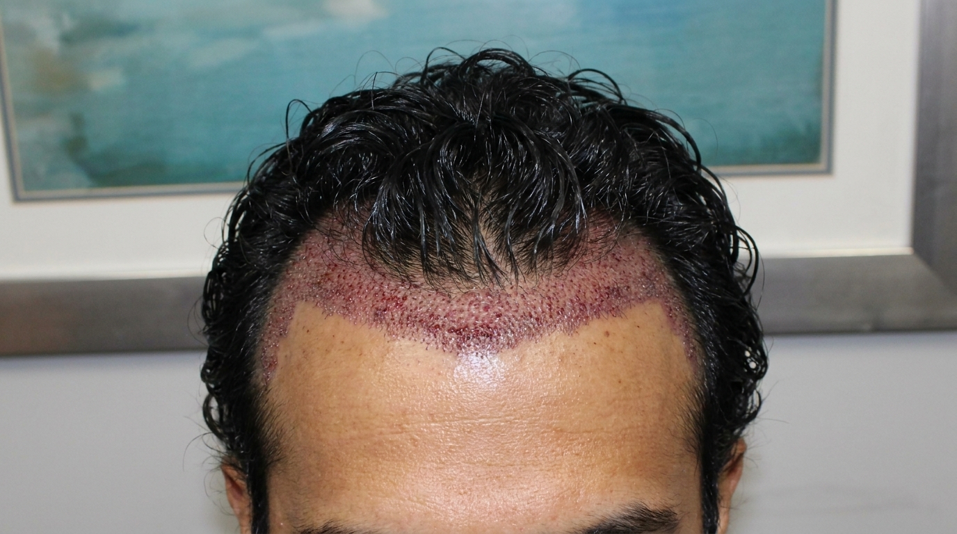 Hair Transplant