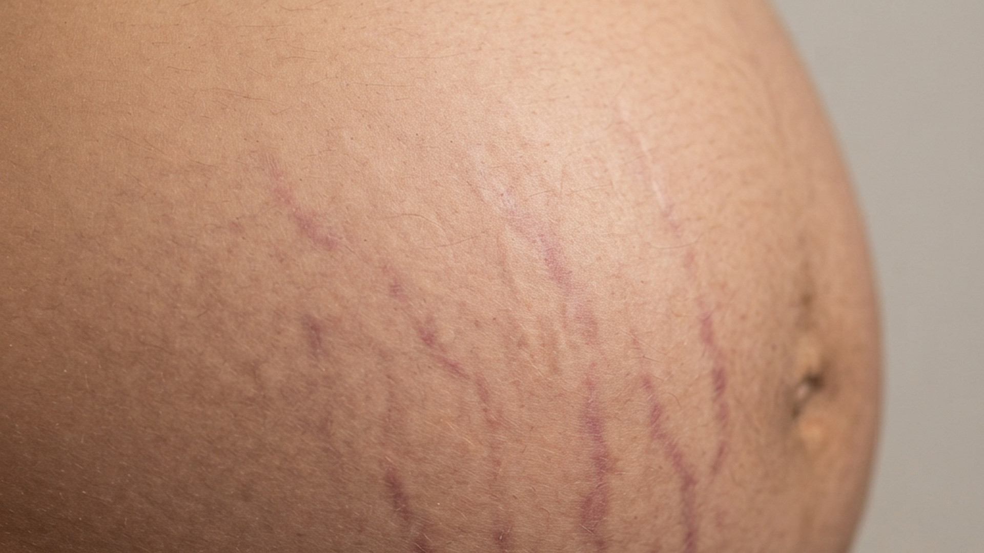 Stretch Marks