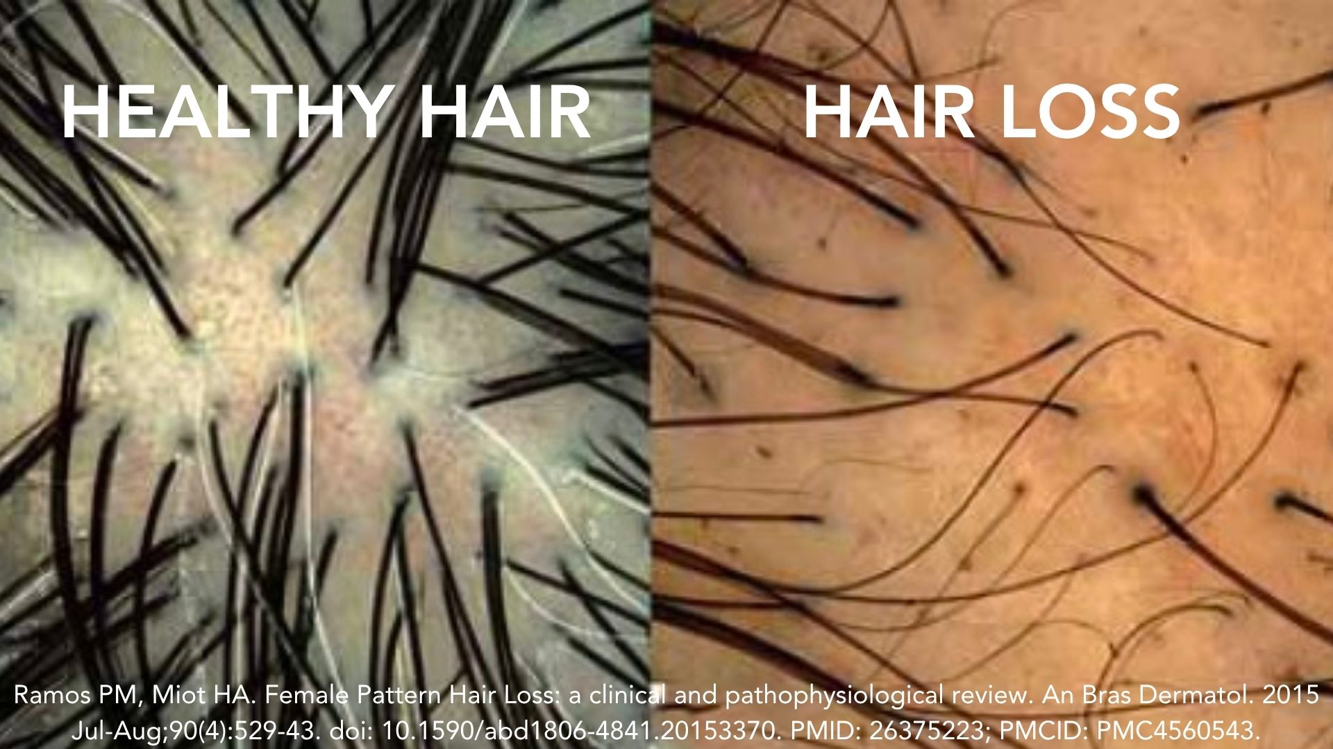 Female Pattern Hair Loss