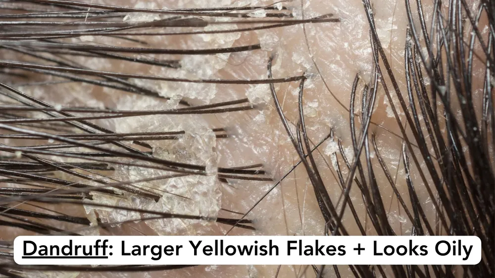 Close-up of a scalp with dandruff: pale skin with larger, loose, yellowish flakes that look slightly oily around the hairs.