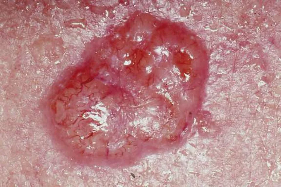 Basal cell vs squamous cell