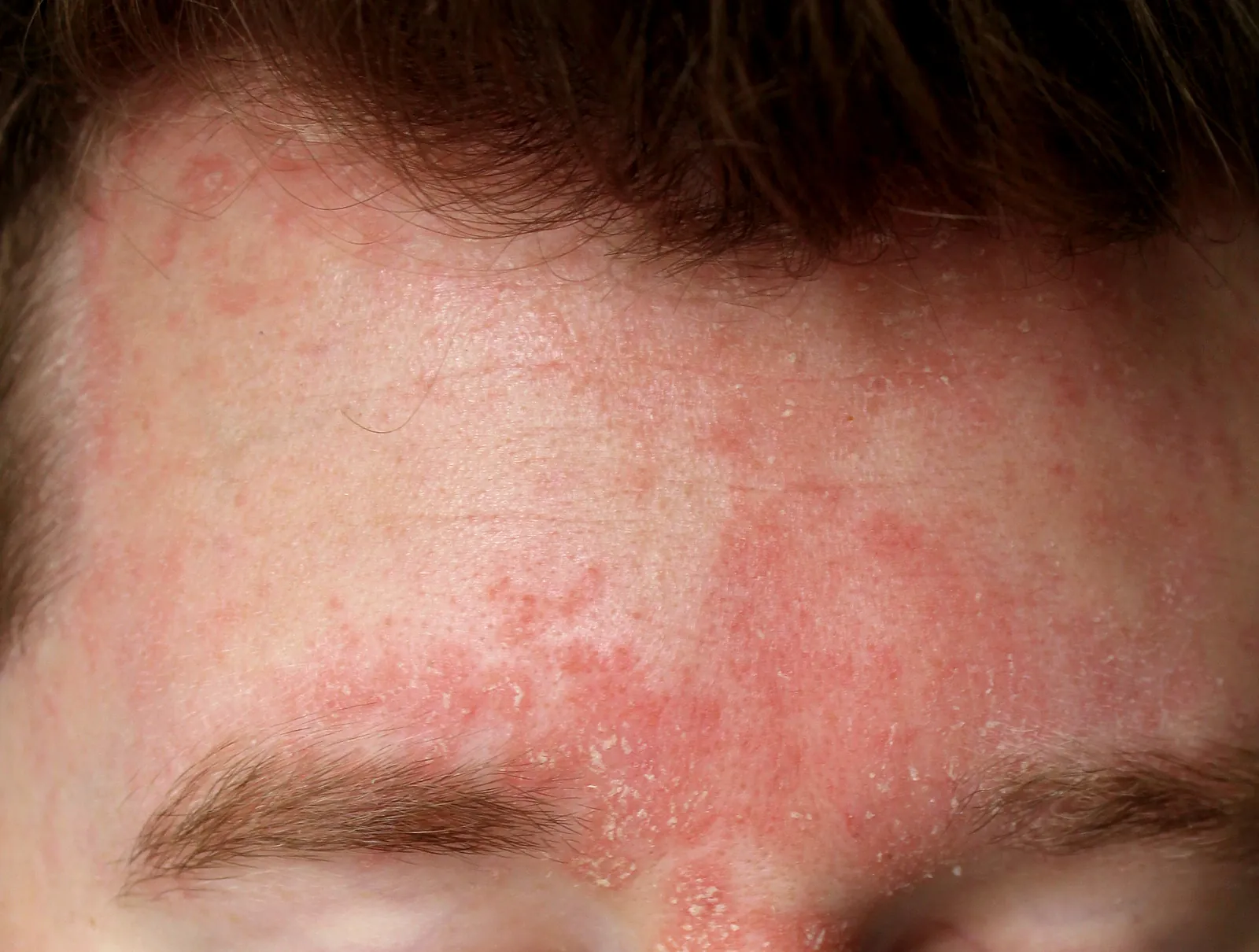 Seborrheic dermatitis