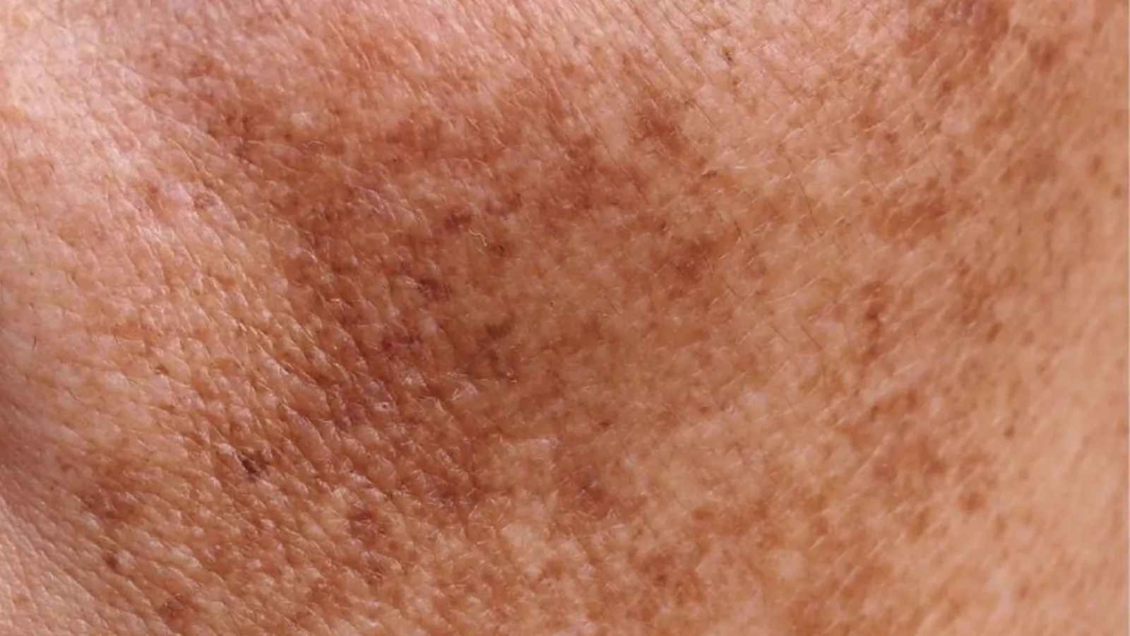 Close-up of skin with scattered brown patches and uneven texture.