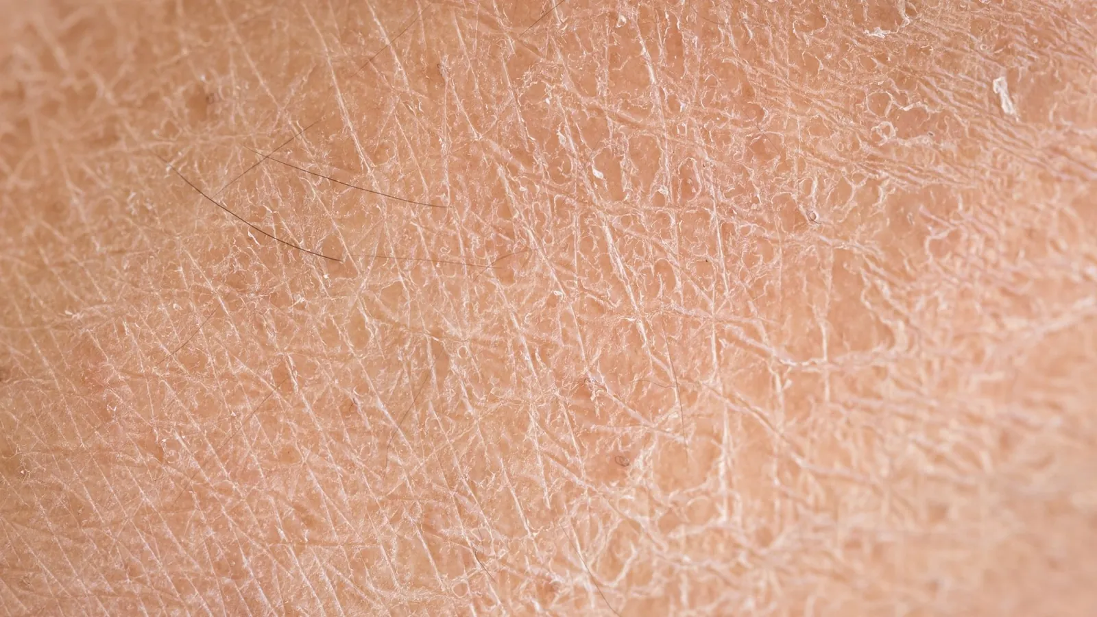 Close-up of dry skin with fine cracks across the surface.