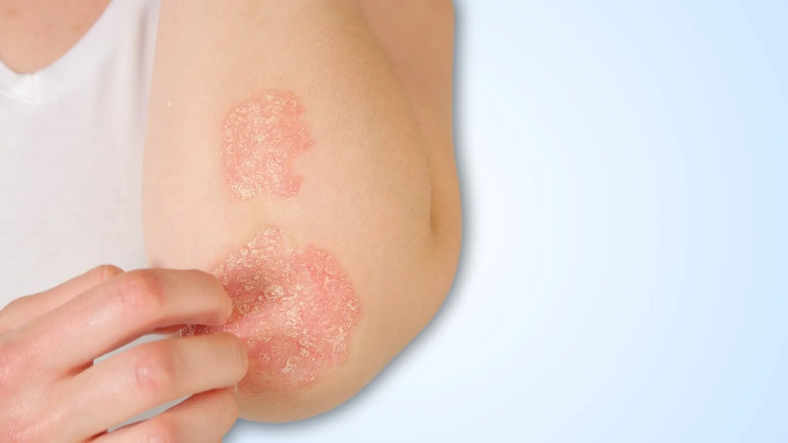 Elbow with raised, scaly pink plaques.