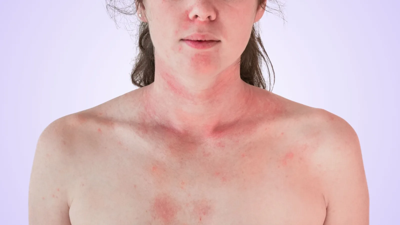 Chest and neck with blotchy red patches.