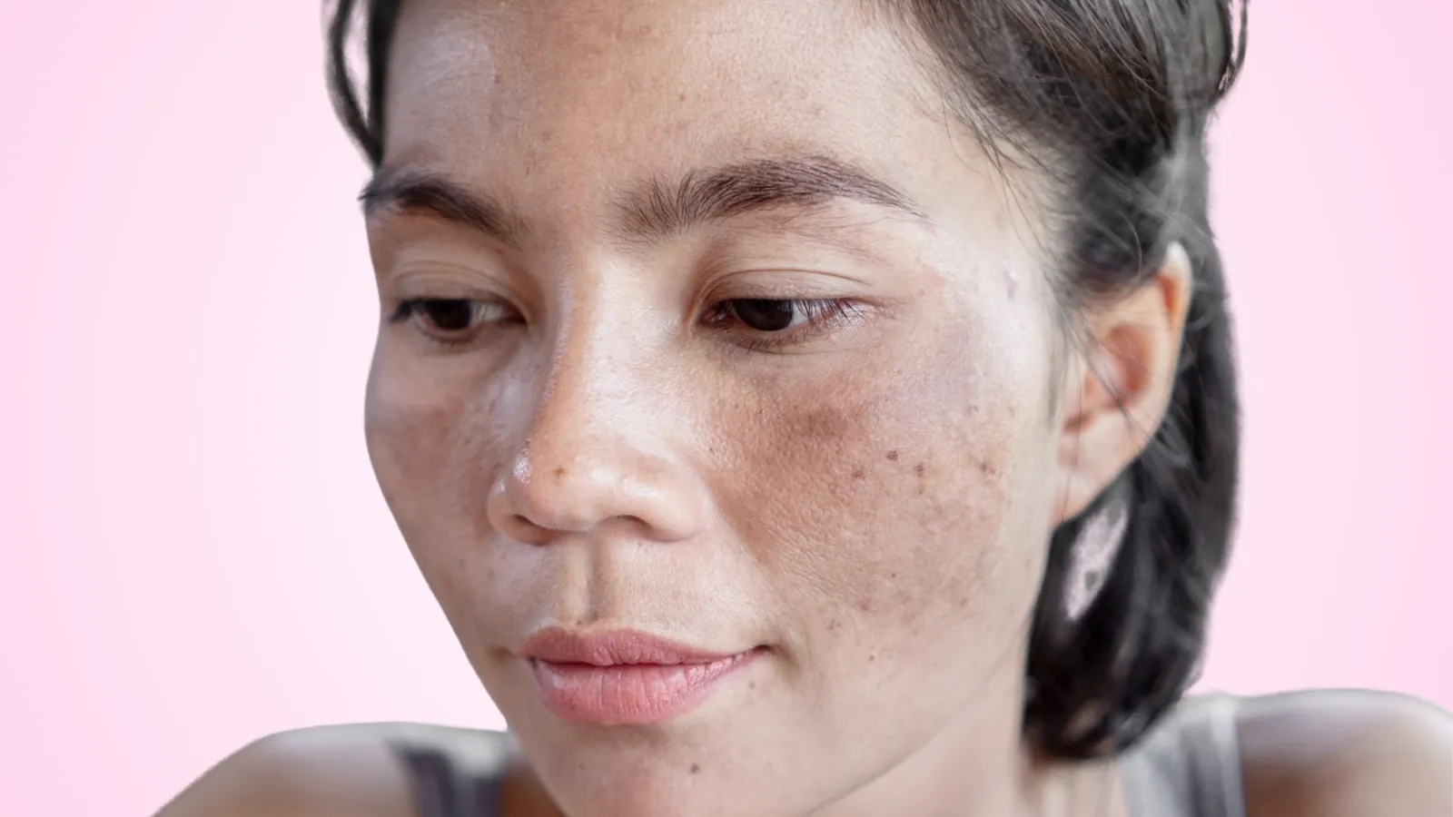 Hyperpigmentation vs freckles