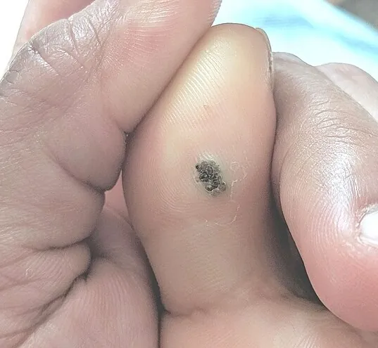 Warts vs molluscum