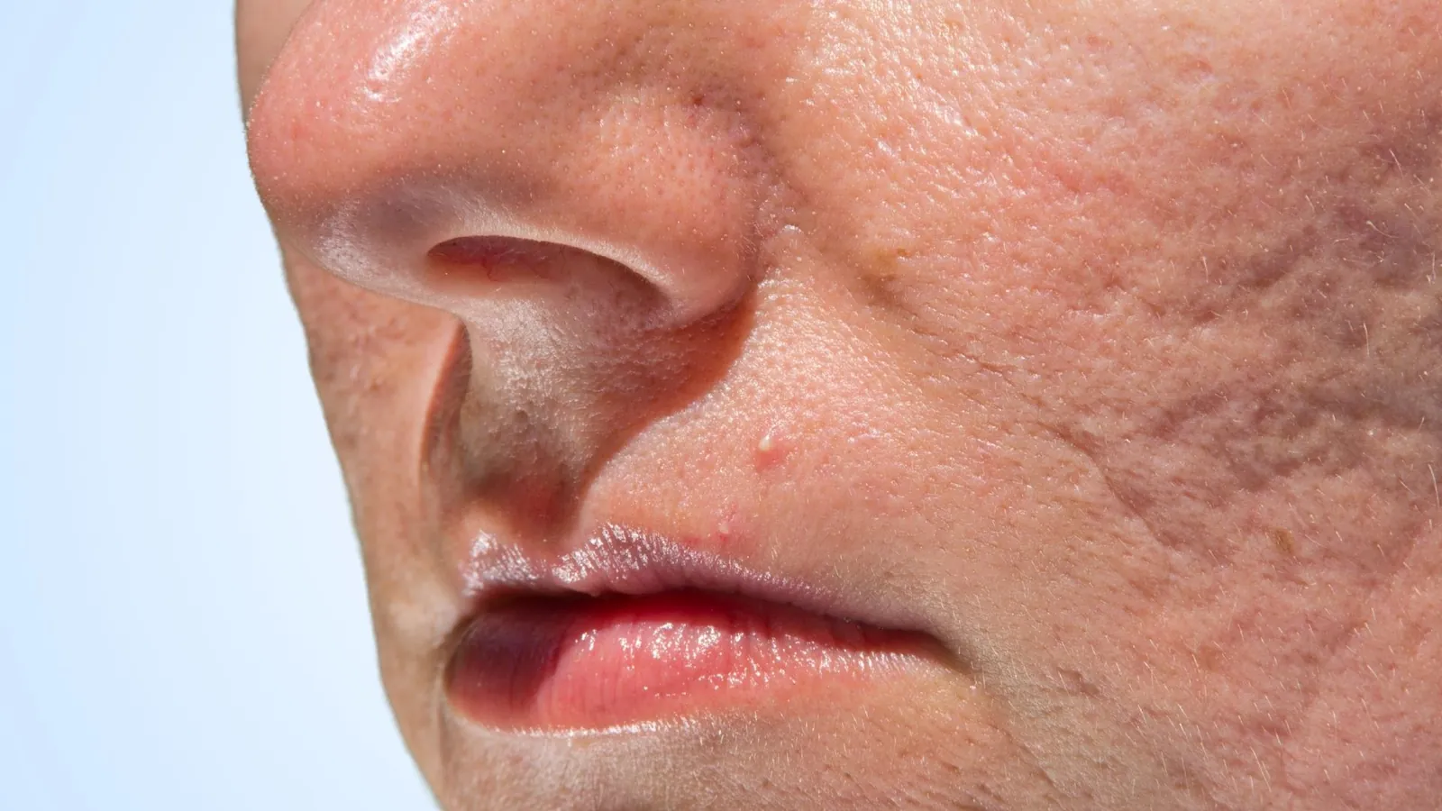 Acne scars
