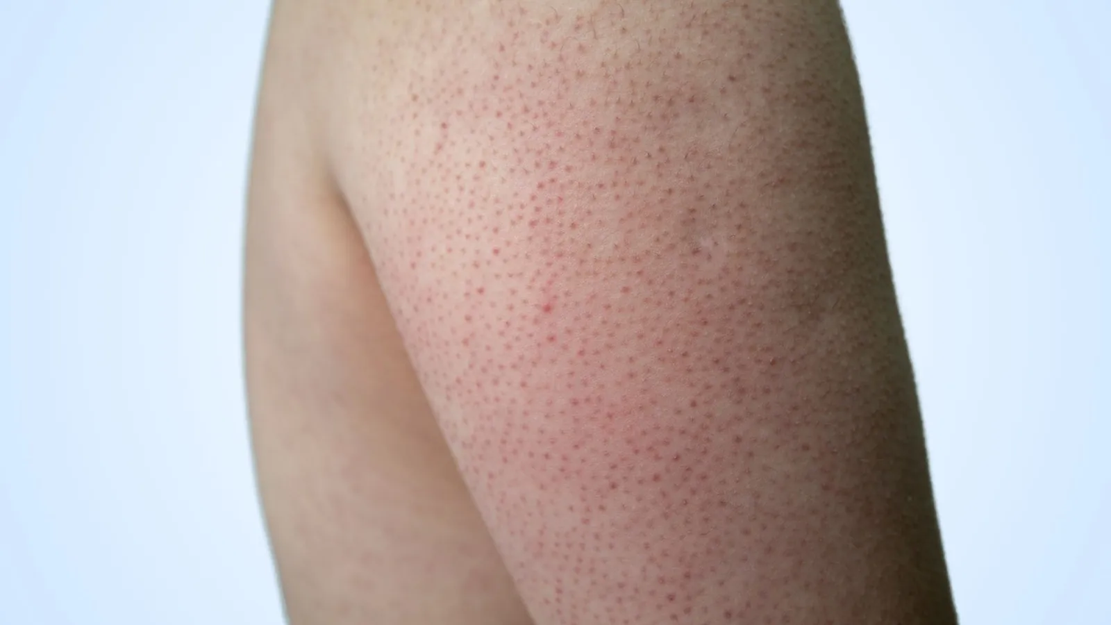 Keratosis pilaris vs rosacea