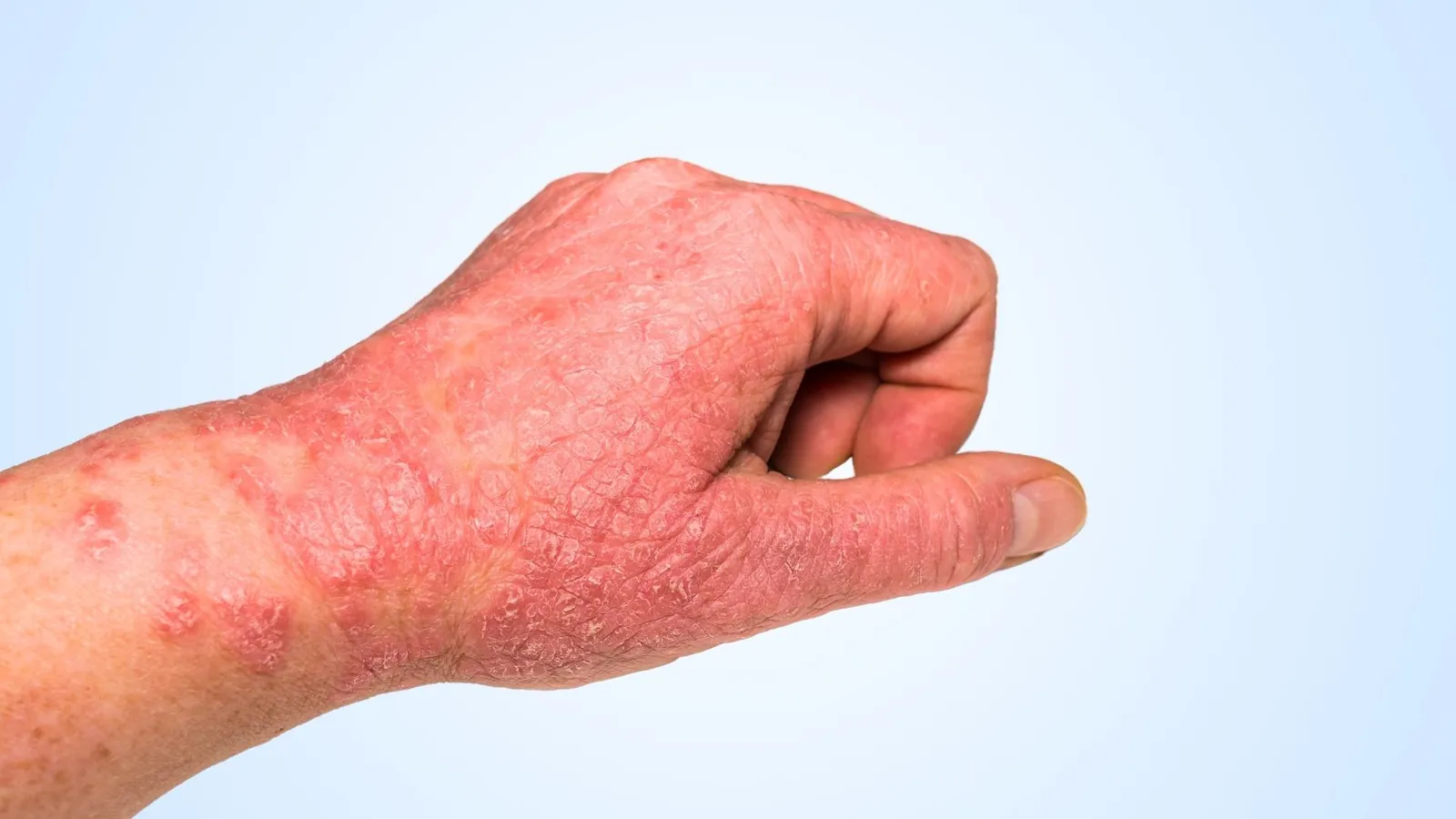 Hand Dermatitis