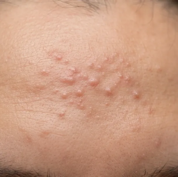 Close-up of a forehead covered in small, evenly sized bumps.