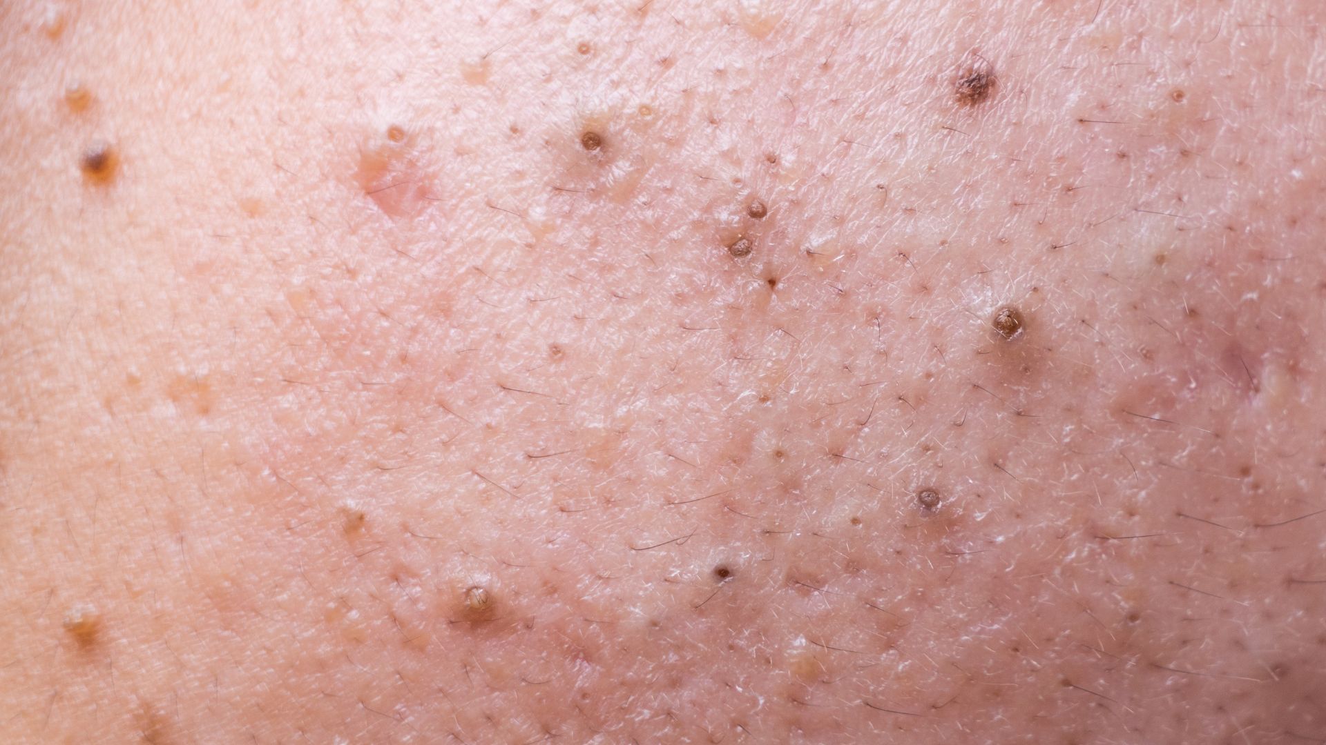 Comedonal acne