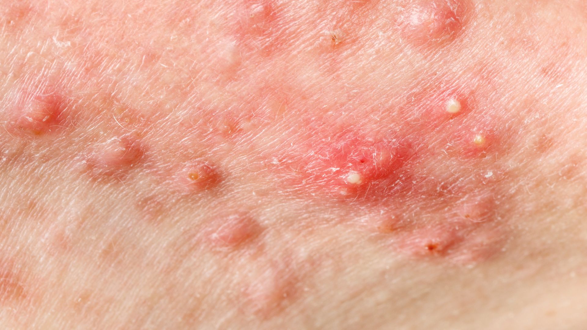 Inflammatory acne
