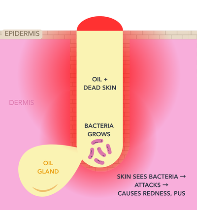 Cross-section of a pore: inflammatory acne