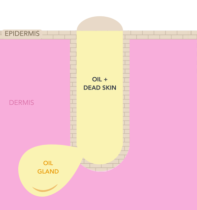 Cross-section of a pore: whitehead