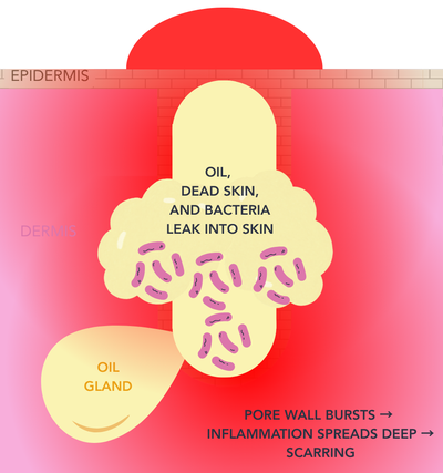 Cross-section of a pore: nodular acne