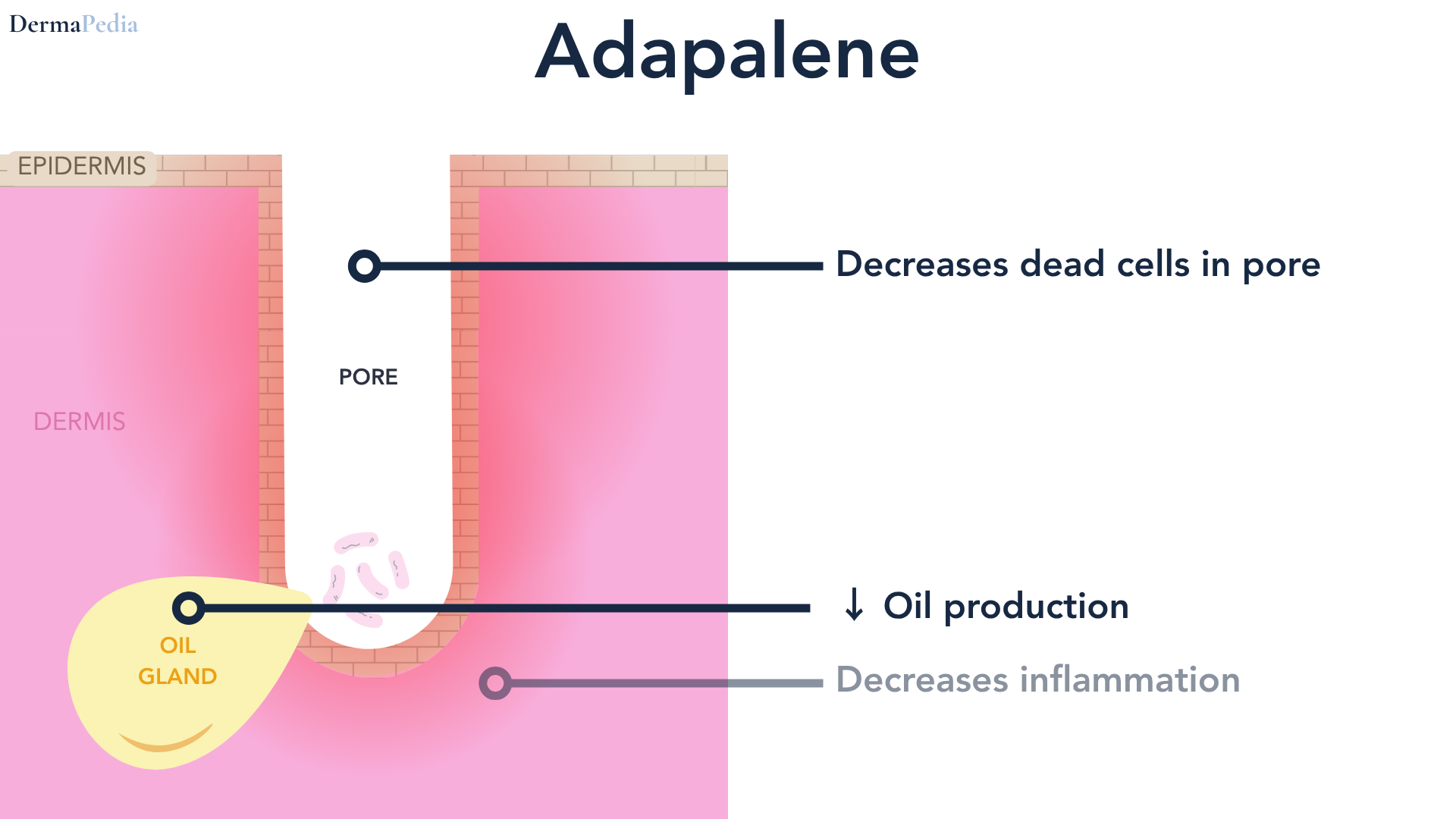 Labeled cutaway diagram of a single skin pore, headed Adapalene. The epidermis is a brick-textured band across the top and the dermis is pink below it, with a yellow oil gland at the base of the pore and a cluster of bacteria inside it. Three callout lines point in: decreases dead cells in pore and decreases oil production are drawn in dark navy as main effects, and decreases inflammation is drawn in gray as a lesser one.