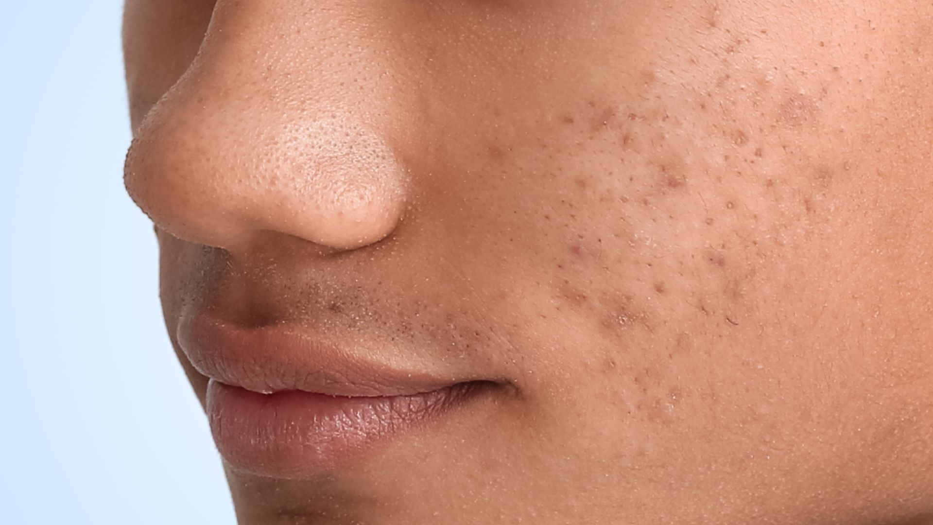 Close-up of the lower cheek, nose and mouth of a young person with medium-brown skin, turned three-quarters away from the camera against a pale blue background. Scattered flat dark brown marks are spread across the cheek, with a few small raised spots still active among them.