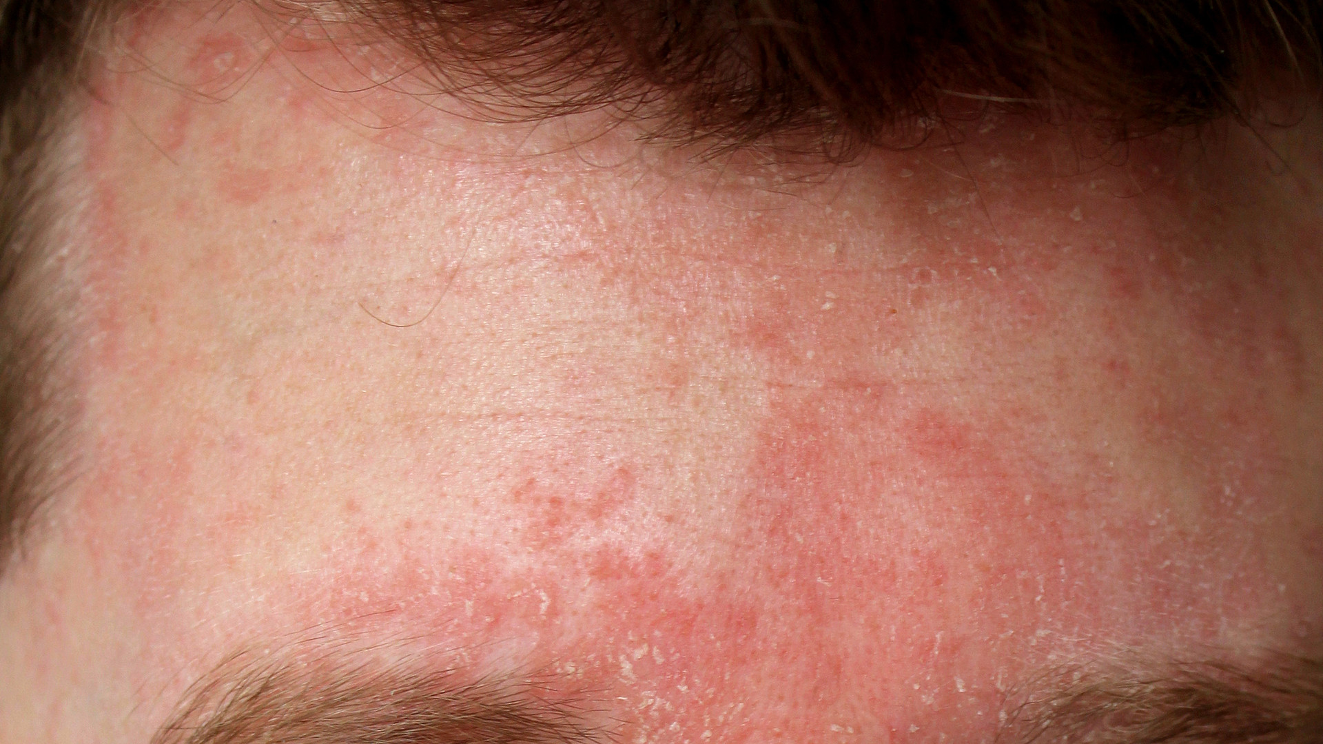 Red skin in the creases beside the nose and across the eyebrow, covered with fine greasy yellowish flakes. The redness follows the folds rather than spreading evenly across the cheek.