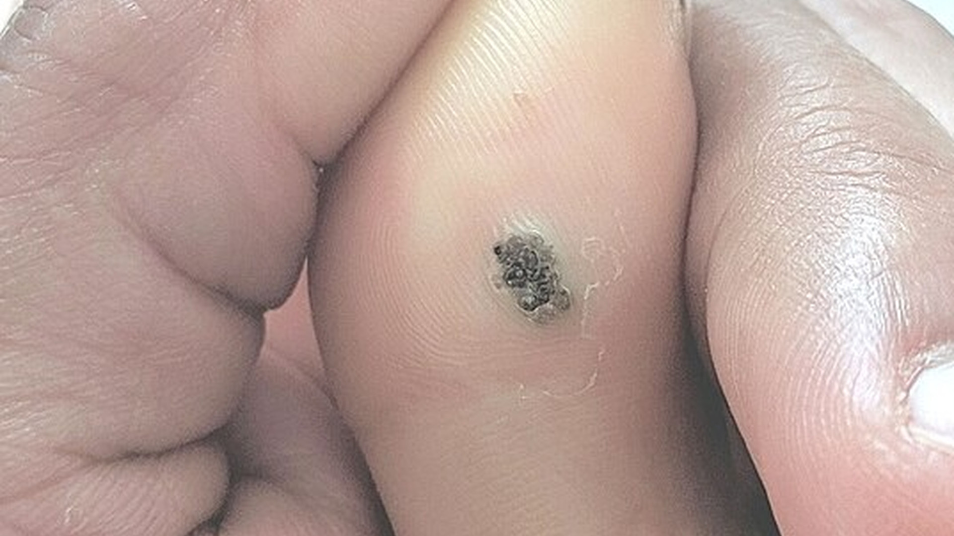 Warts