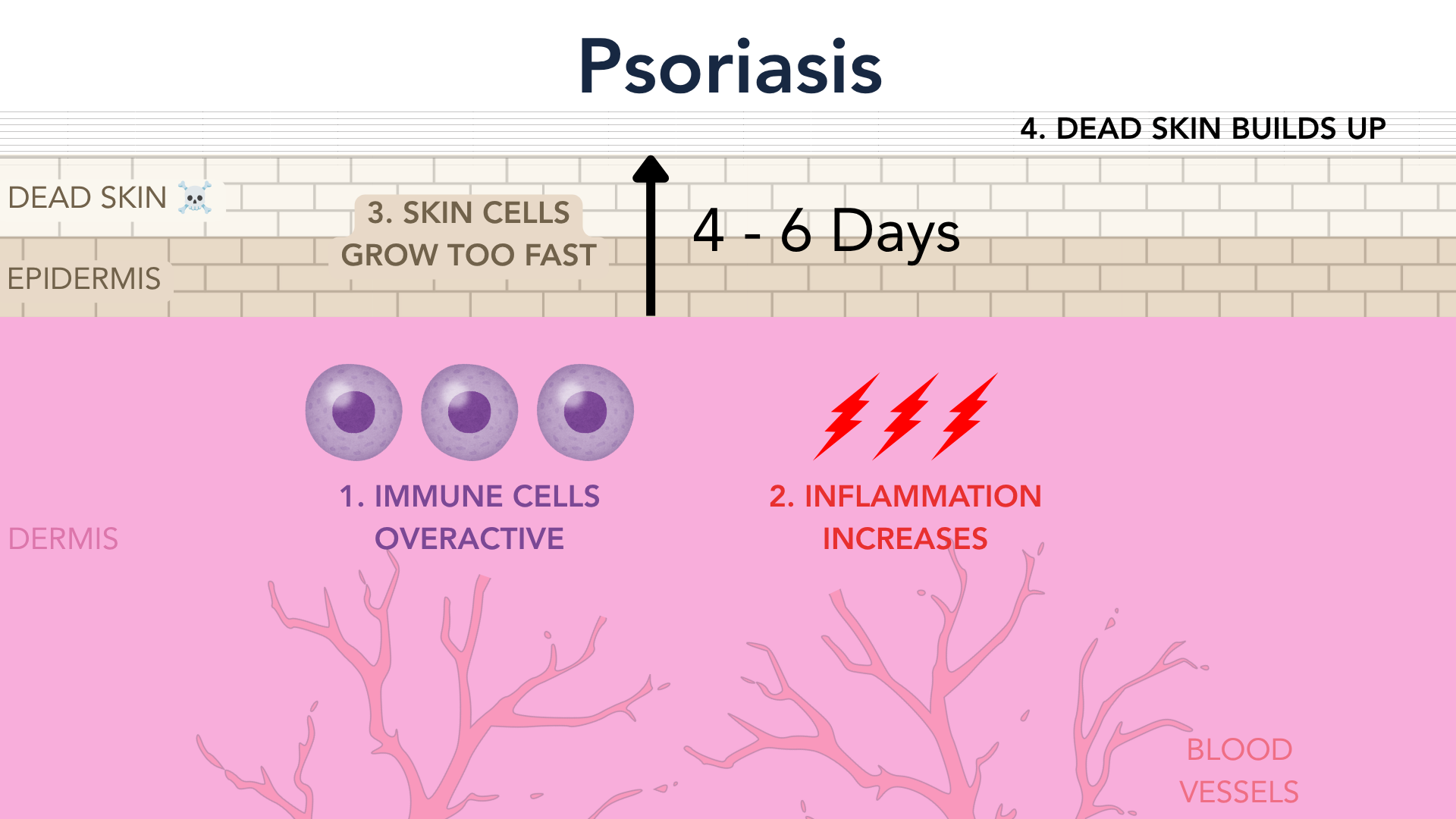 Panel 4 of the psoriasis mechanism figure. A thickened plaque with layers of loose scale on top, and widened blood vessels looping up close to the surface underneath it.