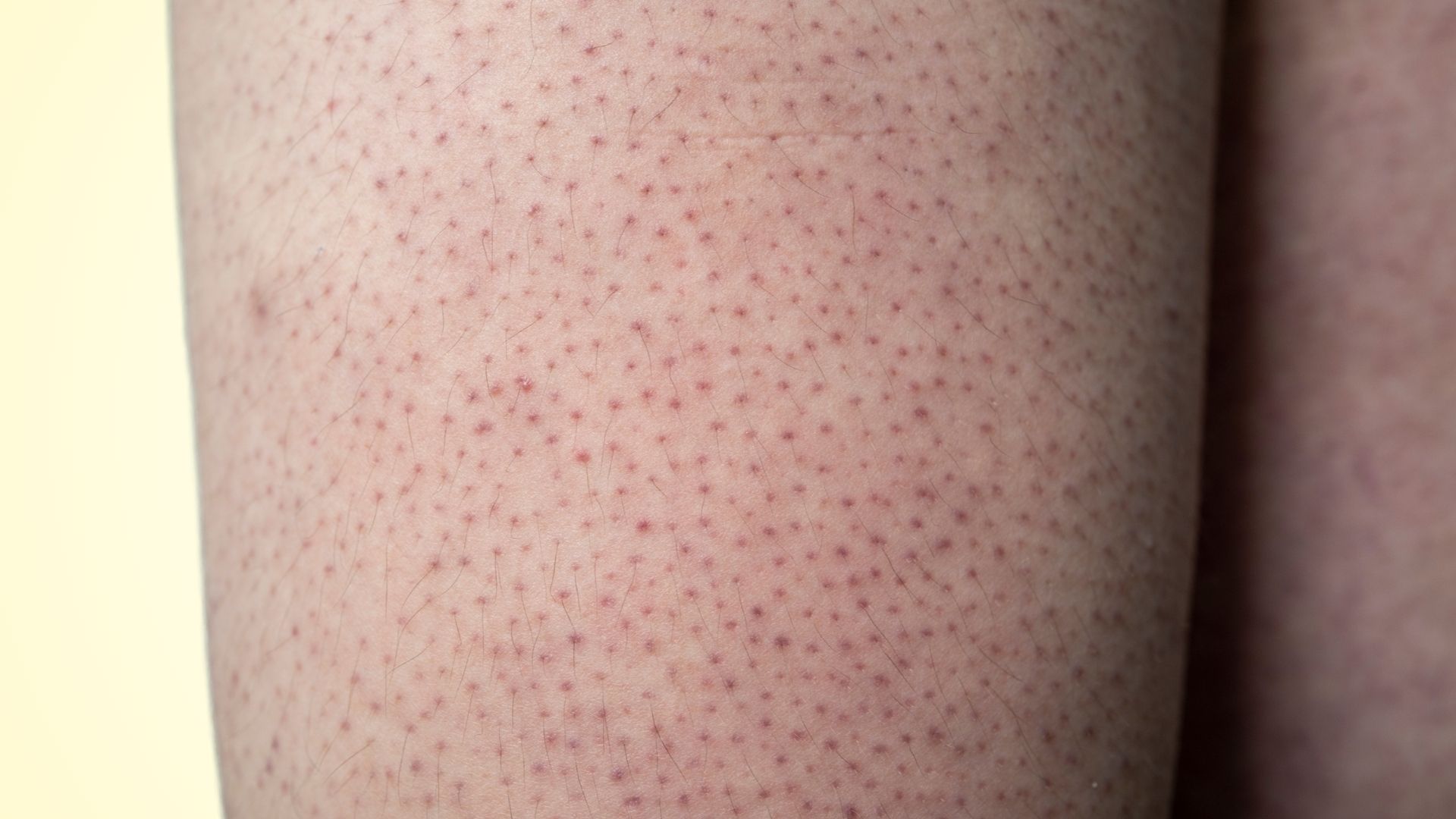 The front of a thigh covered in small rough bumps at the hair openings, evenly spread over a wide area, with dry flaky skin between them and no redness or pus.