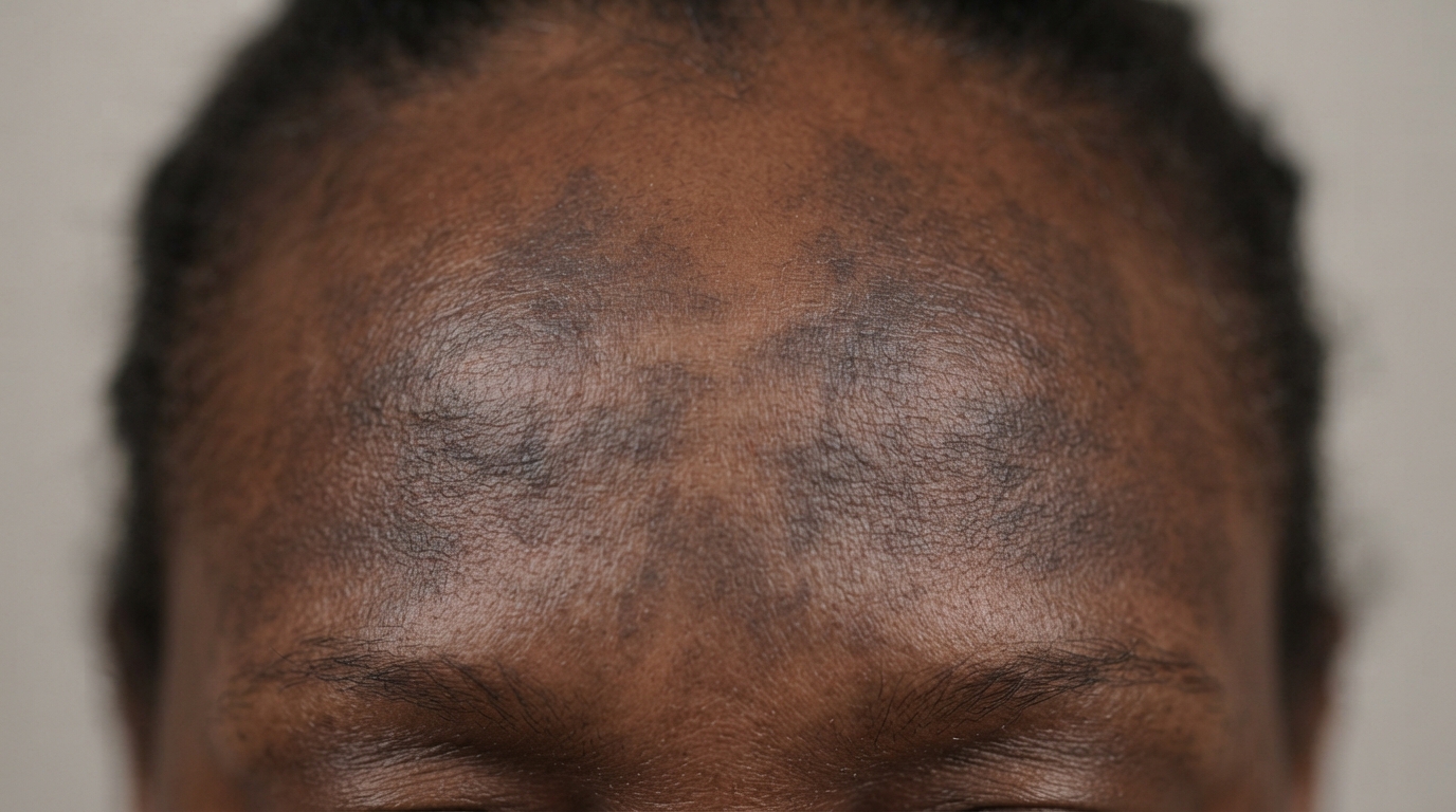 Flat slate gray-brown patches with soft irregular edges across the forehead and upper cheek of an adult with deep brown skin, the surface completely smooth.