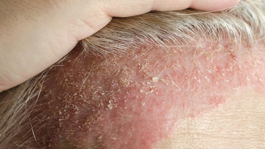 Scalp Psoriasis